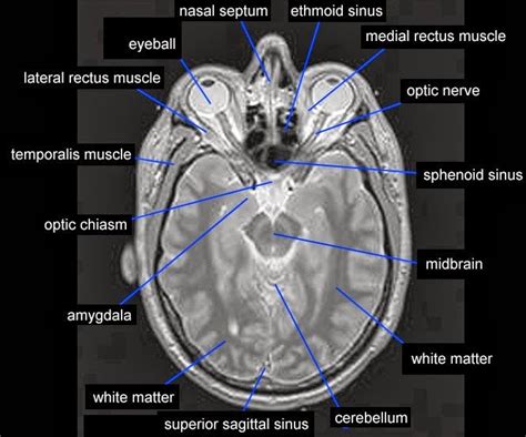 mri temporalis muscle anatomy radiology anatomy images medical radiography radiology