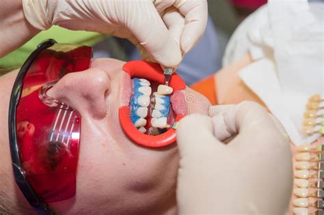 determine the hue of teeth female patient visiting