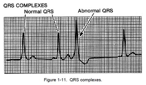 analysis  ekg rhythm strips cardiac rhythm interpretation