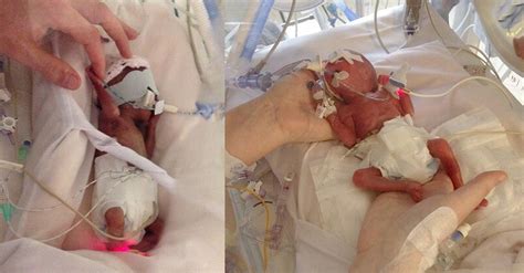 tweeling werd na amper  weken geboren ze waren zo klein het belang van limburg