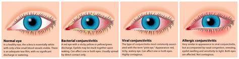natural remedies  pink eye  prepared page