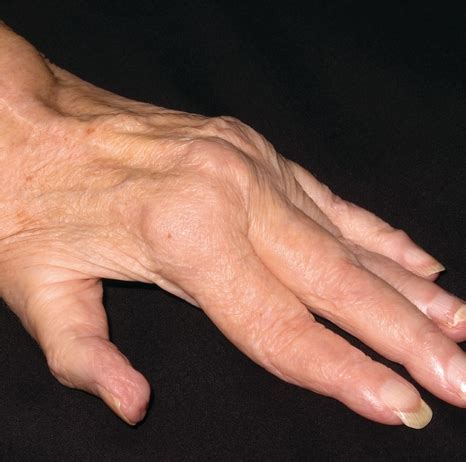 ten top tips  diagnosing inflammatory arthritis pulse today