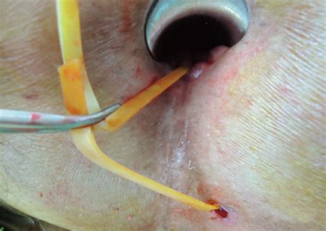 a rubber band was inserted through the fistula tract as open i