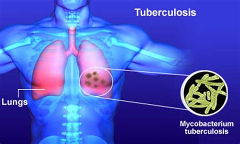 ciencias naturales ceuja  la tuberculosis