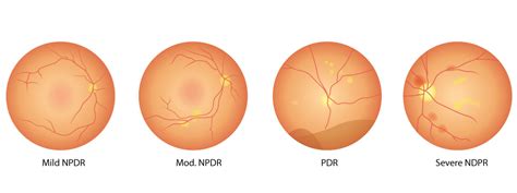 stages  diabetic retinopathy eyeland vision diabetic