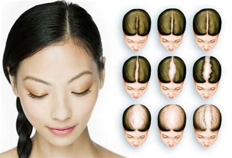 types  hair loss patterns  females  reversible treatment bee choo ladies