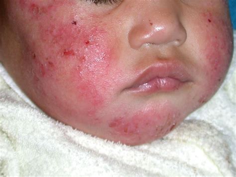 treating childhood eczema  topical solution   topical problem bpj issue
