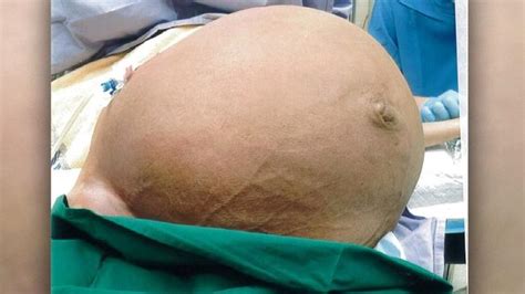 Doctors Remove Massive 28kg Tumour From Woman’s Uterus