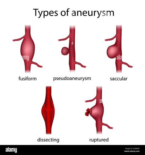 fusiformes aneurysma fotos und bildmaterial  hoher aufloesung alamy