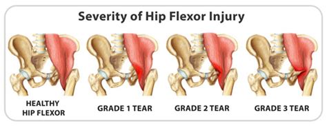 Hip Flexor Strain Signs Causes Treatment And Recovery