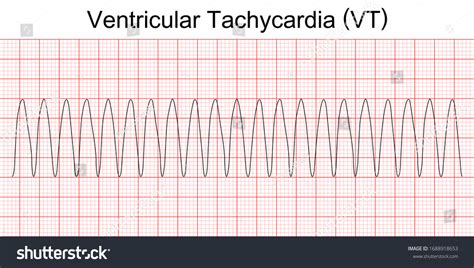 ventricular tachycardia images stock  vectors shutterstock