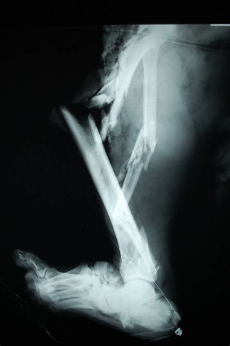 Compound Bone Fracture X Ray Hot Sex Picture