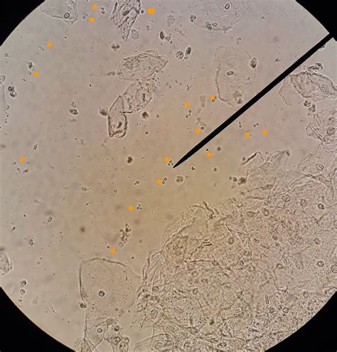 yeast cellsorange  urine sample full  epithelial  bacterial cells