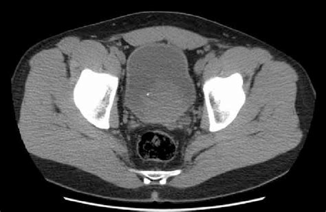 ct image showing  large bladder tumor   posterior bladder wall