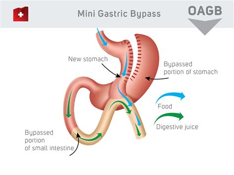 Mini Gastric Bypass Kcm Clinic