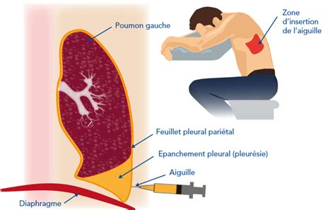 Ponctions Et Biopsies Pleurales