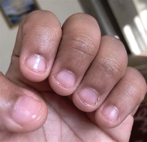 how to stop biting your nails