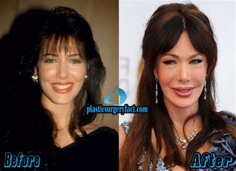 Hunter Tylo Before And After Plastic Surgery Celebrity