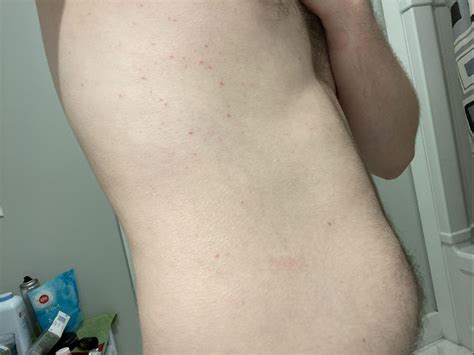 Hiv Rash Spots This Week I Have Been Breaking Hiv Partners