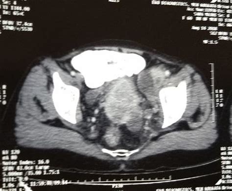 cect scan of pelvis showing bulky cervix and pelvic lymphadenopathy