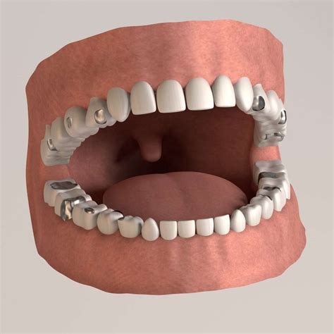 choose   silver amalgam   composite filling highland dental group