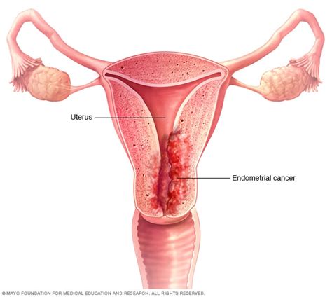 cáncer de endometrio síntomas y causas mayo clinic
