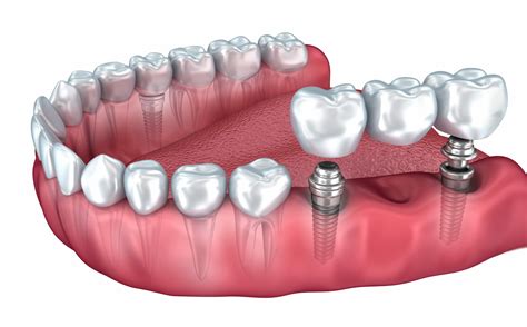 dental implants   popular choice  replace missing teeth kc