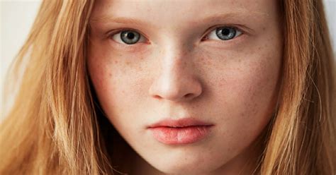 How To Get Rid Of Freckles 5 Effective Ways Fresh Skin Canvas