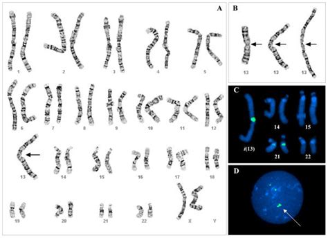 Cytogenetic Analysis Of Patient A 45 Xx I 13 Q10 Chromosomal