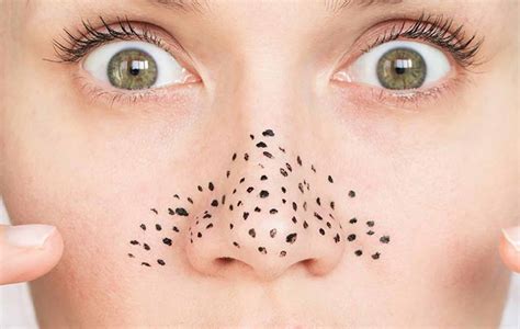 menghilangkan komedo  hidung beauty  clinic