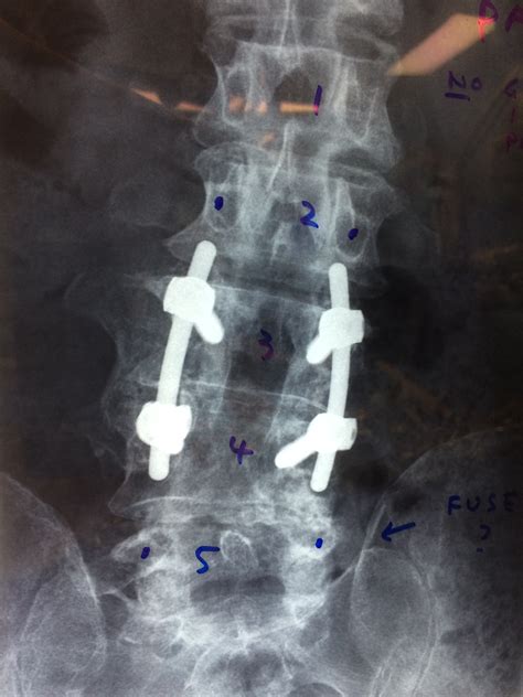 Lumbar Fusion With Pedical Screws Front Range Spine And Neurosurgery