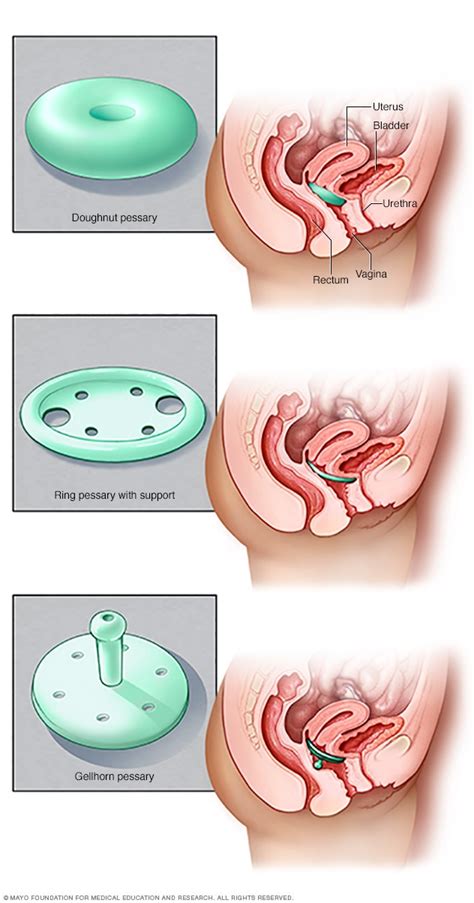 uterine prolapse diagnosis and treatment mayo clinic