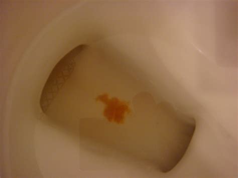 bloody mucus  urine  men  health advisor