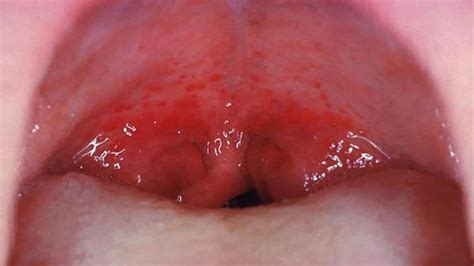 strep throat pictures of tongue the letter of recomendation