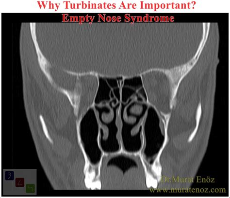 turbinates  important empty nose syndrome