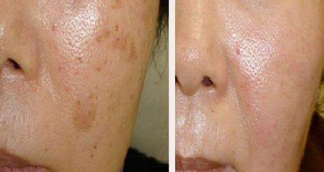 efficient remedies  remove brown spots   face