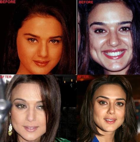 Bollywood Actress Before And After Plastic Surgery Always