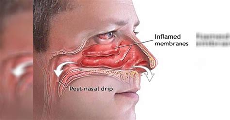 simple trick   clear  clogged sinuses    seconds