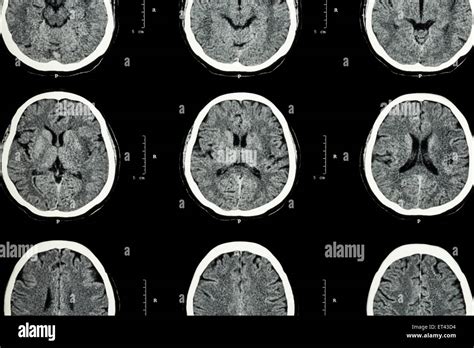 ct scan du cerveau indiquent  cerveau normal contexte neurologique photo stock alamy