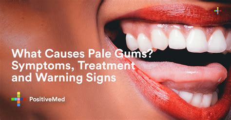 pale gums symptoms treatment  warning signs positivemed