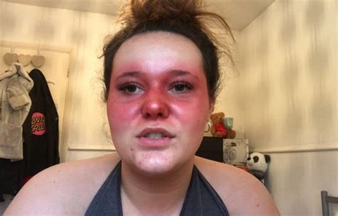 teenager  lupus rash   face shows    minute beauty routine metro news
