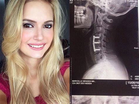a 23 year old woman was temporarily paralyzed after doing a sit up