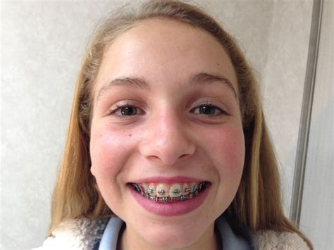 cute girls with braces