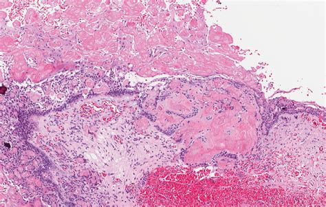 pathology outlines who classification