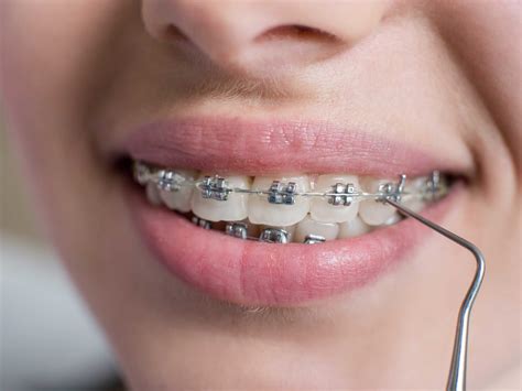 clear braces  metal braces       demotix