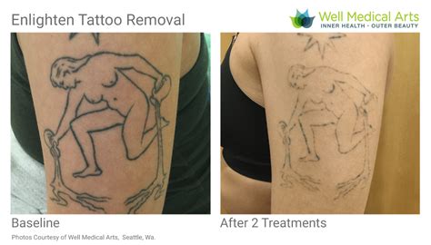 discover    tattoo removal technology super hot incdgdbentre