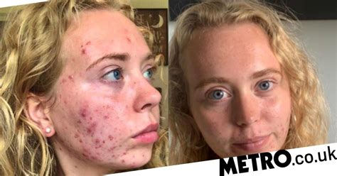 Woman Who Developed Acne At Nine Won T Let It Control Her Life Metro News
