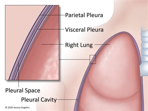 Indwelling Pleural Catheter Pleurx™ Oncolink