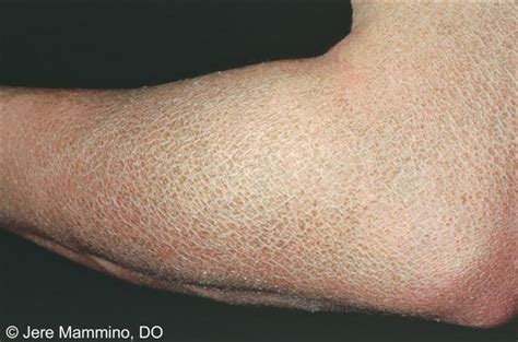 ichthyosis x linked ichthyosis sex linked steroid sulfatase deficiency disease