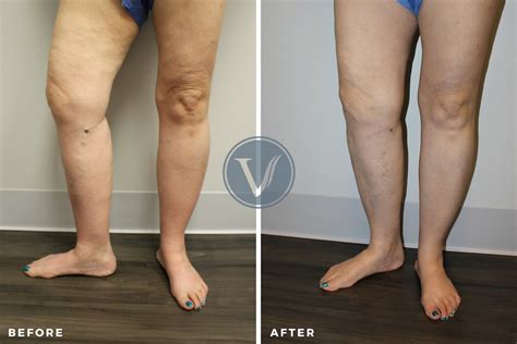 restless leg syndrome treatment the vein institute at ssa